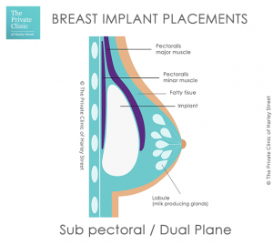 Breast Implants