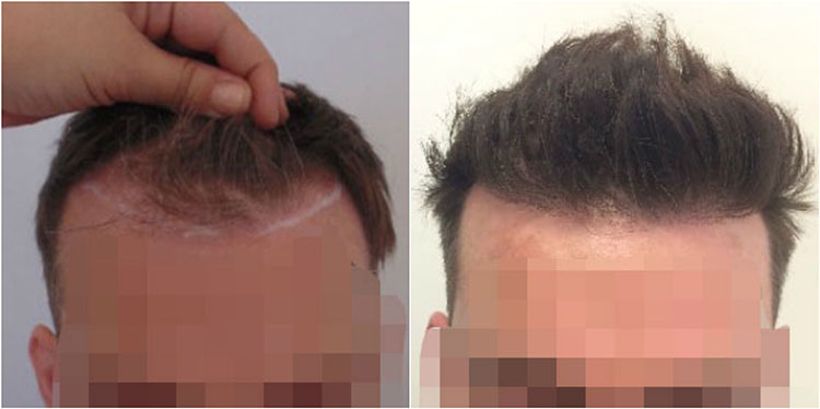 Fue Hair Transplant To Fix Receding Hairline And Temples Hair