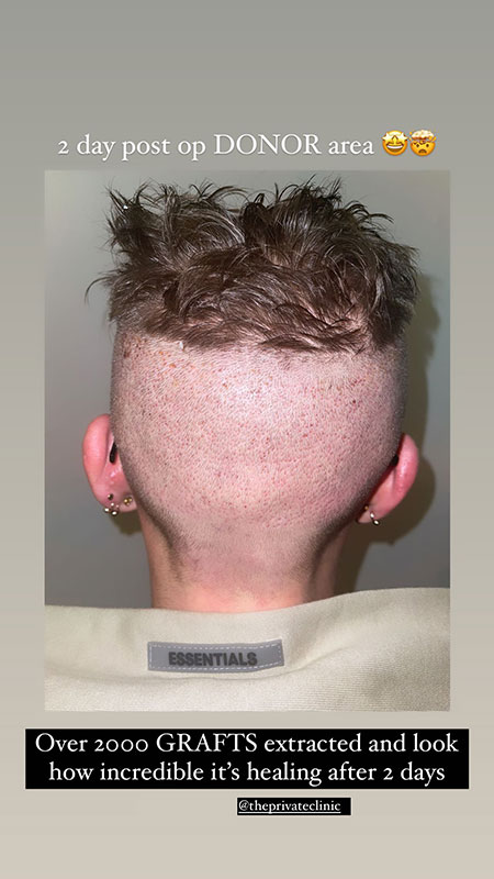 Hair Growth After Hair Transplant After Follicular Transfer Fue Hair