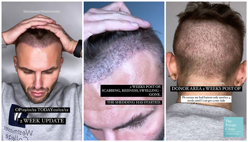 What is Shock Hair loss after Hair Transplant Surgery 