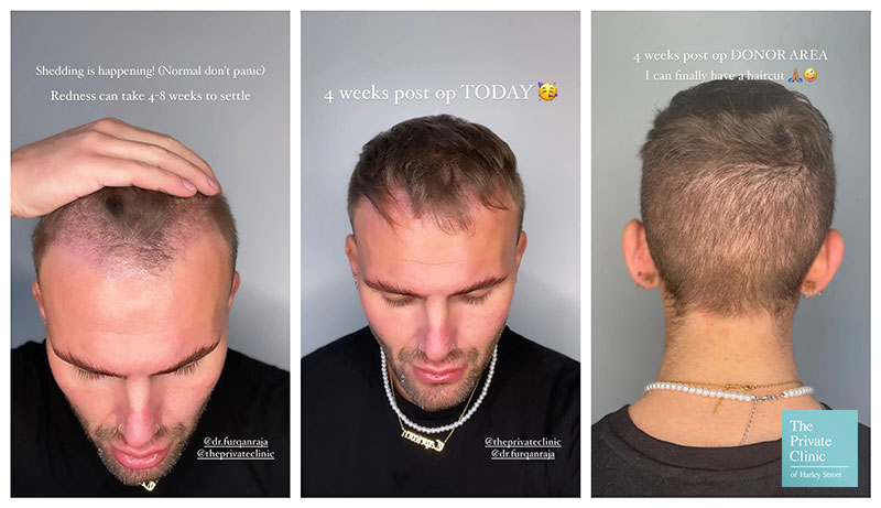 Hair Transplant Growth Timeline  Day By Day Recovery Photos