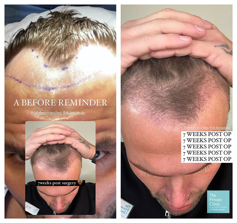 Hair Transplant After 1 Month Photos Results Side Effects