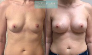 breast augmentation enlargement boob job near me before after results