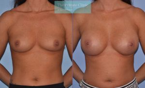 breast augmentation boob job surgery before after photo results