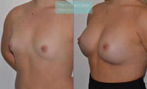 breast augmentation enlargement clinics uk before after results