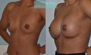 breast enlargement uk london before after results