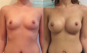 breast-enlargement-implants-clinic-london-before-after-results-007-300x182.jpg