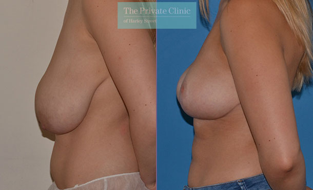 breast reduction surgery and uplift results