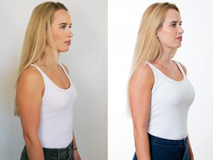 Breast Enlargement Surgery Amy Breast Implants Restore Nature Volume   Breast Implants Enlargement Augmentation Before After Photos Amy 300x225 