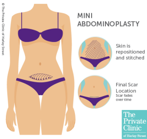 What's the difference between mini tummy tuck (mini-abdominoplasty