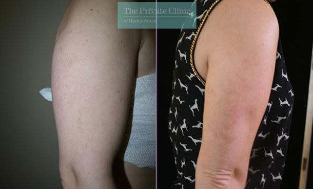 Patient #5715 Liposuction Arms Before and After Photos Beverly