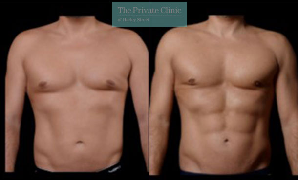 Liposuction for Men Before & After Photo Gallery, Louisville, KY