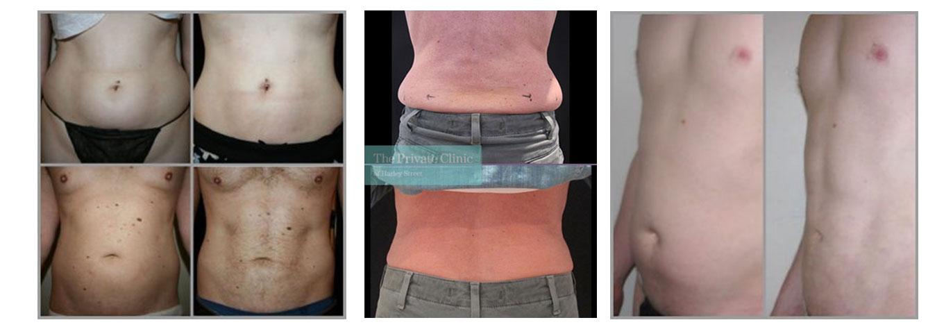 Achieve Your Ideal Body with Non-Surgical Body Contouring