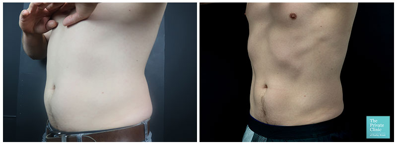CoolSculpting Male Lower Abdomen Before After Pictures, Men Flanks