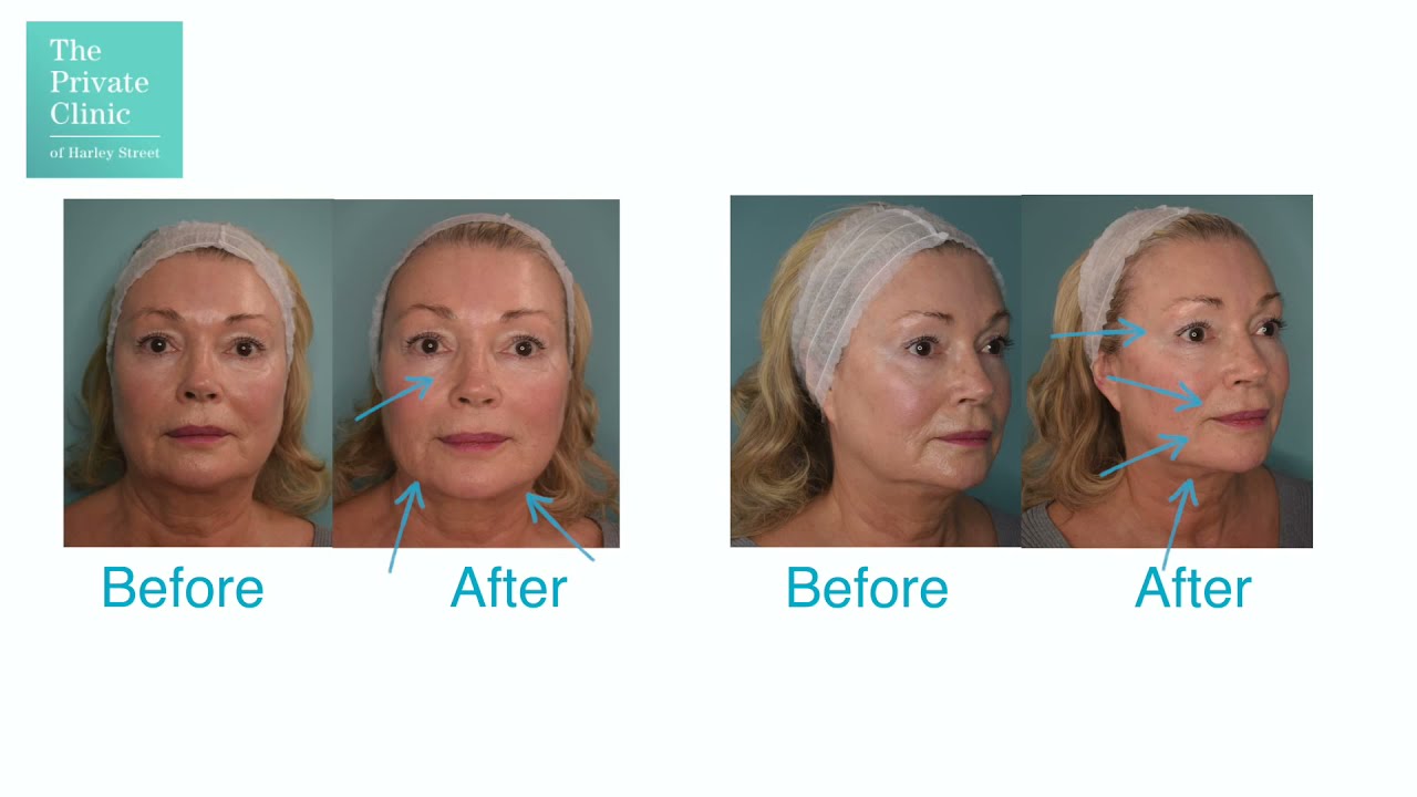 8 Point Face Lift Near Me Treatment 8 Point Lift Fluid Facelift London The Private Clinic