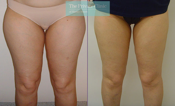 Thigh Lift: Procedure and Results - Harley Clinic