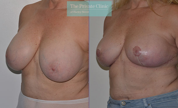 Breast auto augmentation before after results angle mr adrian richards 031AR