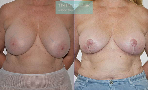 Breast auto augmentation before after results front mr adrian richards 031AR