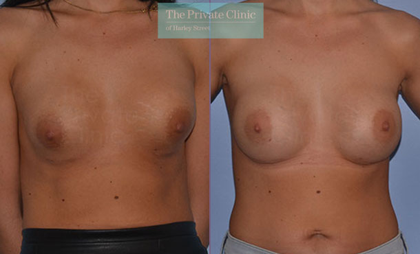 Breast Implant Removal Replacement - 048AR-Front