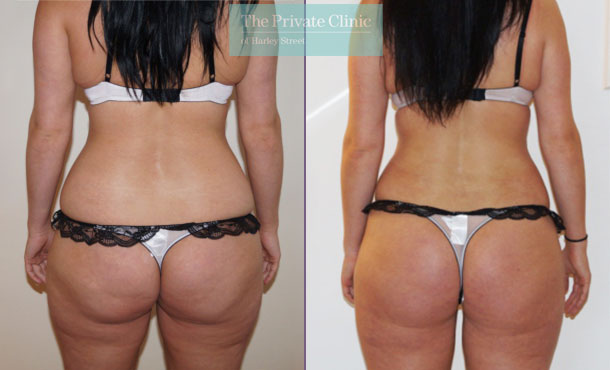 https://www.theprivateclinic.co.uk/wp-content/uploads/2020/09/bra-fat-buttocks-36-vaser-liposuction-lipo-before-after-photos-london-the-private-clinic-back-003TPC.jpg