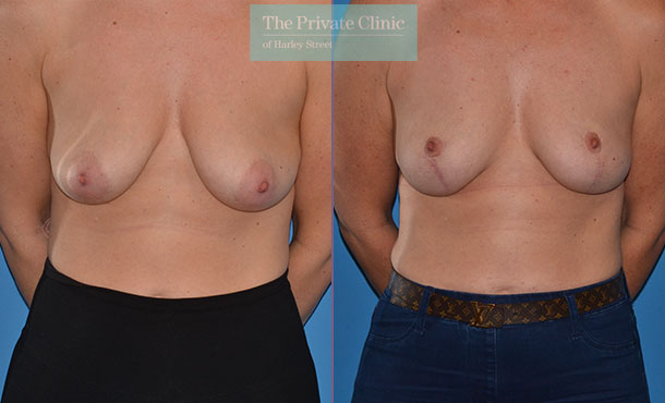 Breast Uplift Surgery - Mastopexy