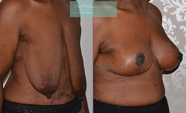 Breast Uplift - 016AR-Side - The Private Clinic of Harley Street
