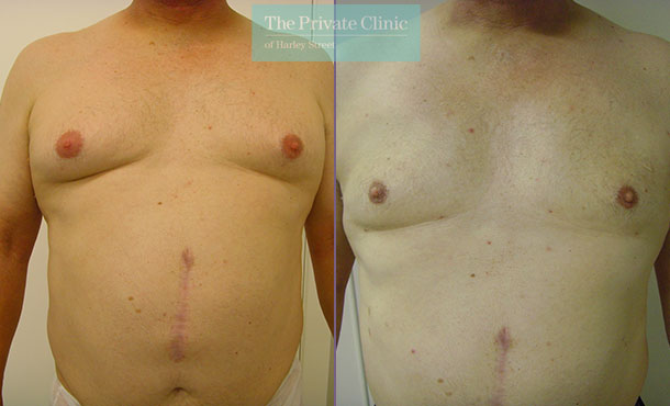 Male Chest Reduction - 001TPC-Front - The Private Clinic of Harley