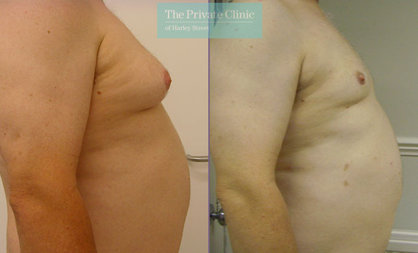 Male Chest Reduction - 001TPC-Front - The Private Clinic of Harley