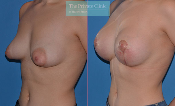 Tuberous Breast Correction - 045AR-Side