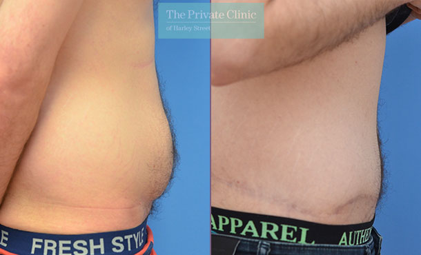 Tummy Tuck - Before & After Images - The Private Clinic of Harley Street  London