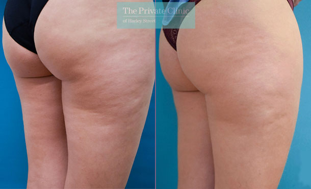 Injection mesotherapy cellulite - cellulite treatment products