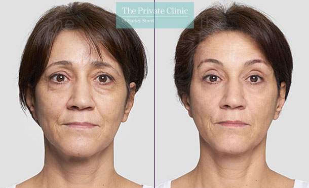 Thread Lifts Uk Facelift Without Surgery Non Surgical Thread Face Lift Silhouette Lift