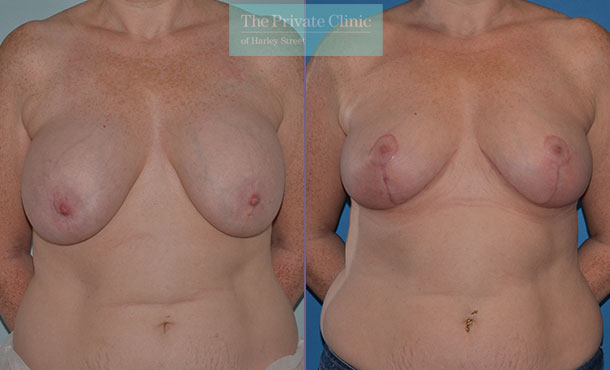 Breast Auto Augmentation - 059AR-AA-Front