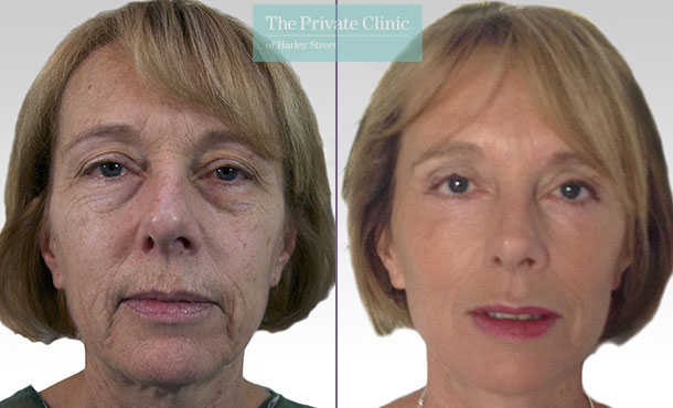 Face Lift The Private Clinic