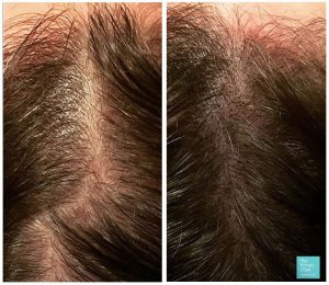 Female Scalp Micropigmentation before and after photo UK