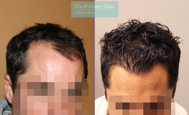 follicular unit transplantation fue before after photos dr raghu reddy 031RR