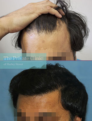 fue hair transplant grafts before after photos london results dr raghu ...