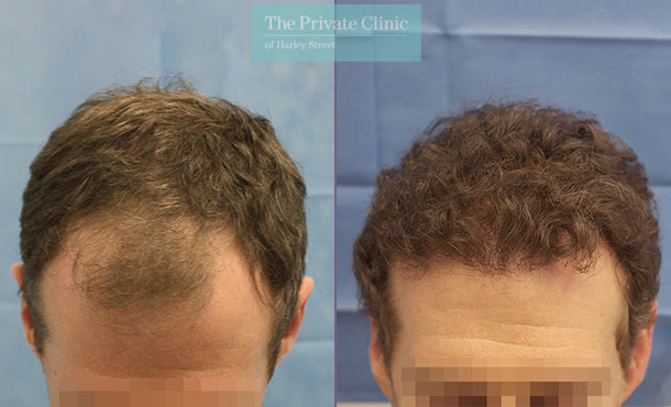 FUE Hair Transplant - 080RR-Front