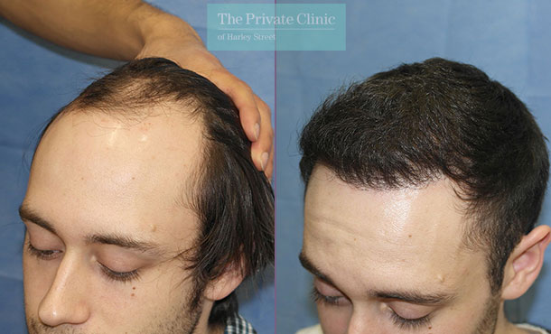 london clinic fue hair transplantation before after photos results dr raghu reddy side 086RR