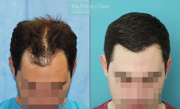 non surgical hair transplant before after photo london results dr raghu reddy front 129RR