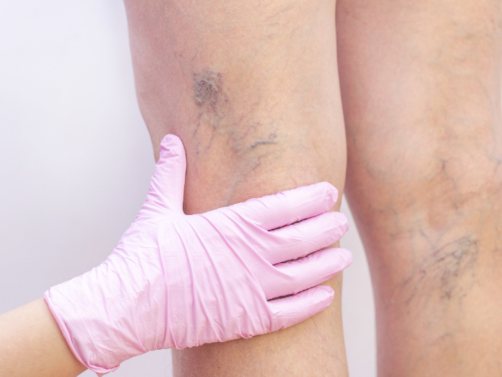 microsclerotherapy-thread-veins