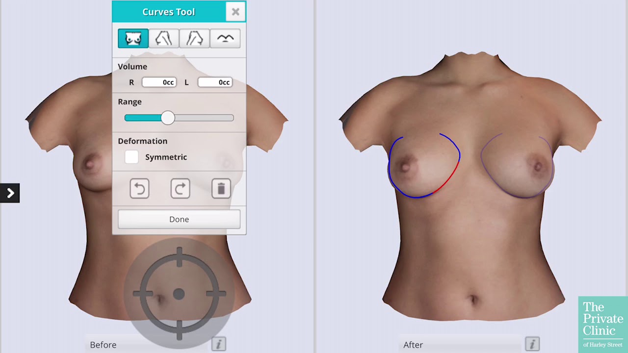 Breast Implant Simulator, Breast augmentation 3D simulator, breast  enlargement 3D images