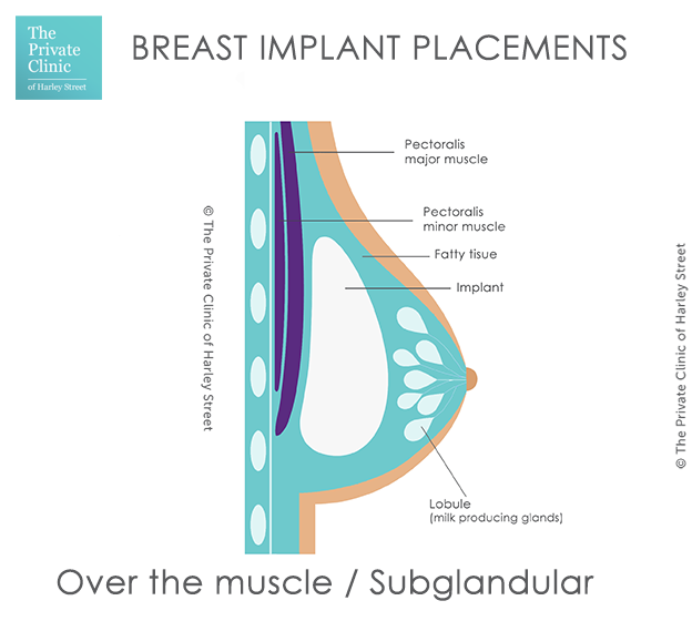 Breast Implant Placement options: dual plane/ Over or Under the Muscle for breast  implants