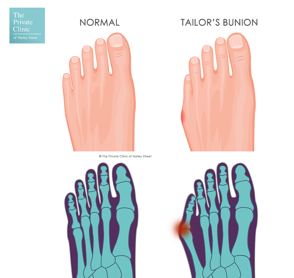 BunionETTE Bootie-Splint-Sock (Big Toe and Small Toe Bunion