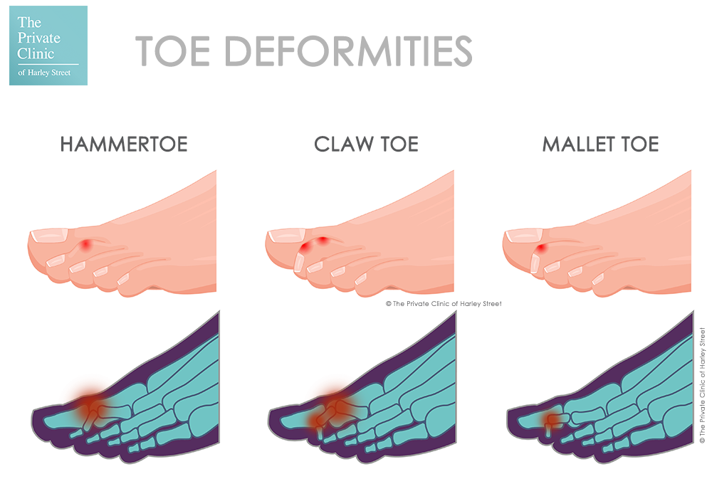 How to Treat Hammer Toes?