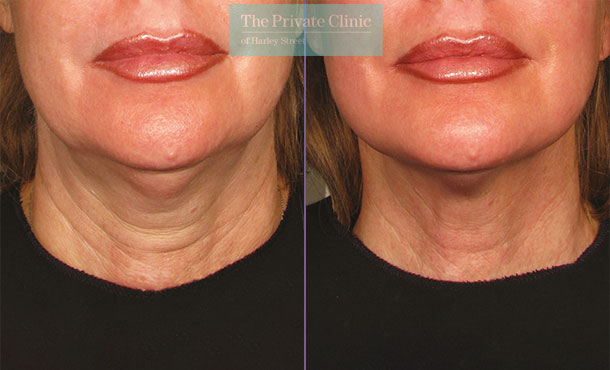 https://www.theprivateclinic.co.uk/wp-content/uploads/2021/06/ultherapy-tech-neck-treatment-necklift-non-surgical-skin-tightening-before-after-results.jpg