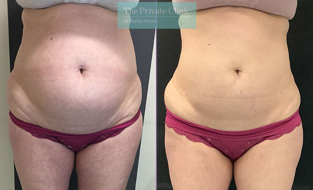 CoolSculpting - 001EA-Front - The Private Clinic of Harley Street London