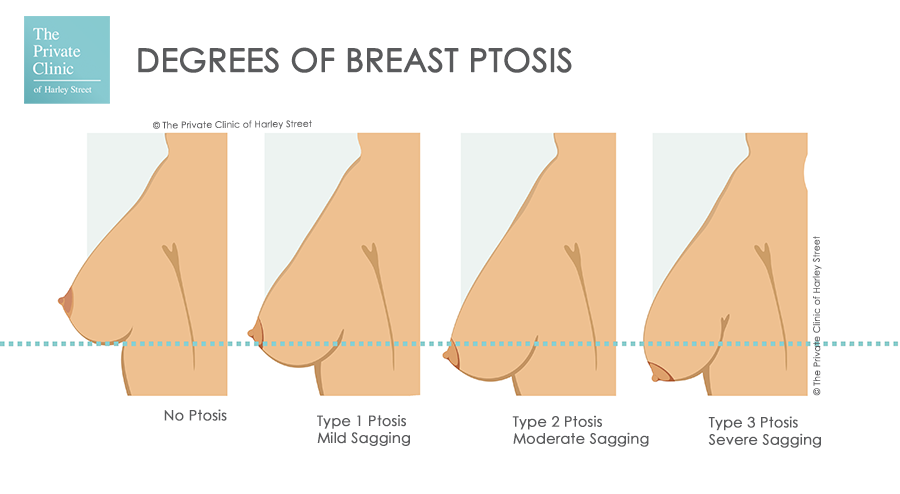 Saggy Breasts, Breast ptosis : sagging breast fix surgery, breast