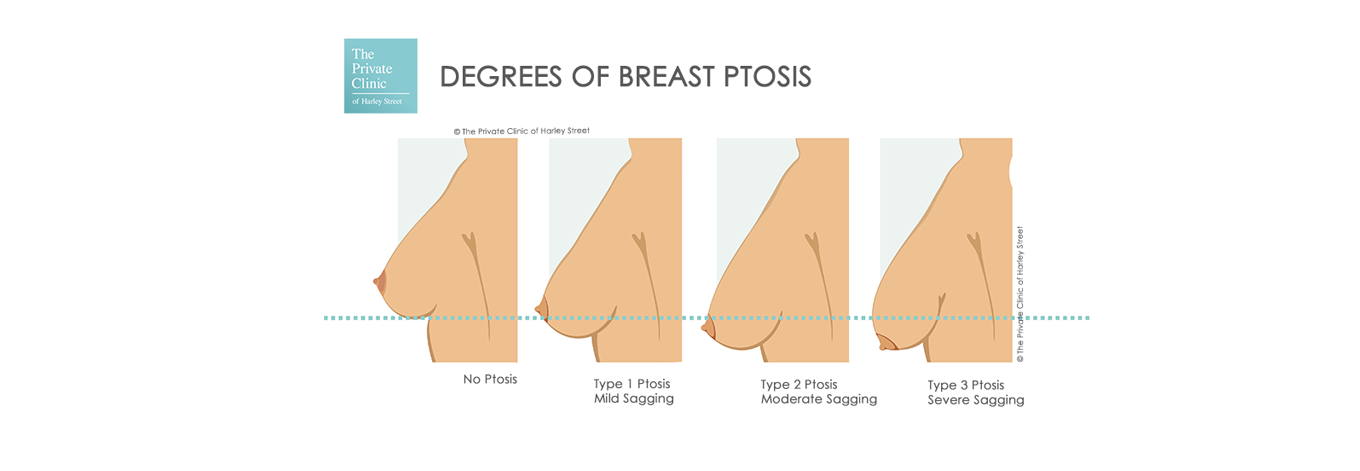 Options for Sagging Breasts after Weight Loss - Erdem Clinic