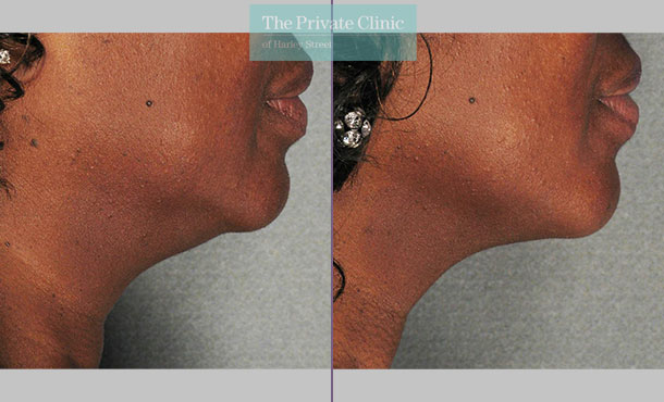 ultherapy necklift non surgical skin tightening results